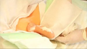 Уход за больным после инсульта. Гигиена мужчин.