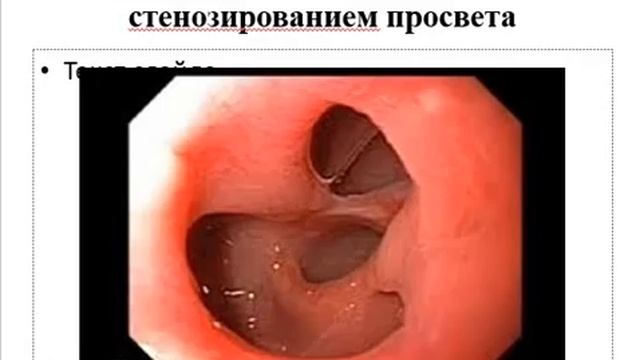 Язвенная болезнь желудка и двенадцатиперстной кишки и ее осложнения смотреть онлайн