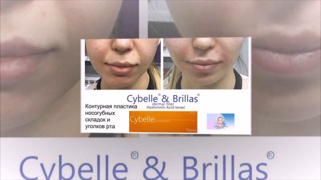инъекционные препараты гиалуроновой кислоты Cybelle® & Brillas® производство Израиль смотреть онлайн