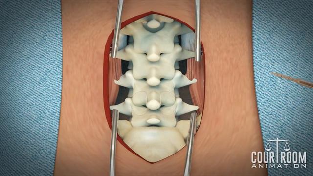 Lumbar Discectomy Surgery: Medical Animation смотреть онлайн