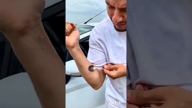 Как избавится от укуса комара смотреть онлайн