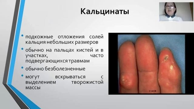 Системные заболевания соединительной ткани, лекция для студентов 5 курса