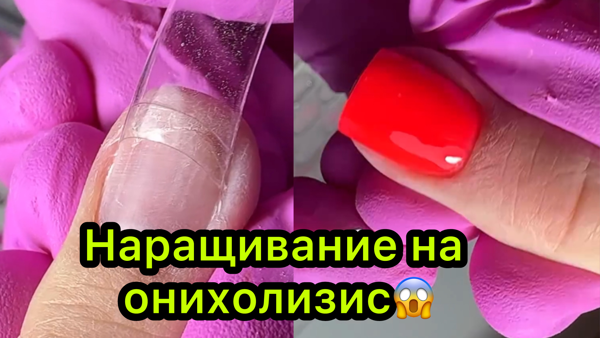 Наращивание на онихолизис😱
