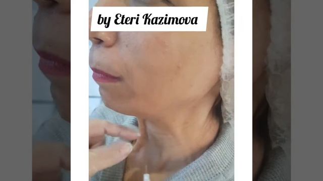 #Омоложение шеи смотреть онлайн