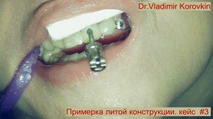 Примерка литого литого колпачка и аббатмента на импланте  21.  Кейс #3.