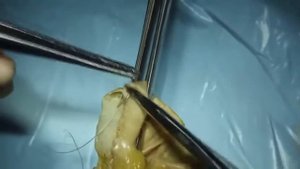 Кишечный анастомоз.  Часть II.