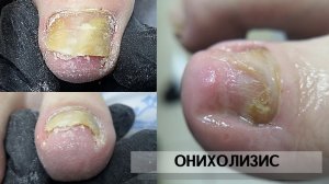 МАСТЕР ВИНОВАТ_ОНИХОЛИЗИС_ГРИБОК НОГТЕЙ