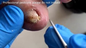 Pedicure Tutorial: Misshapen Toenails, Twisted Growths!【Xue Yidao】