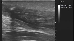 Тендинит ахилла с энтезопатией и кальцинатами