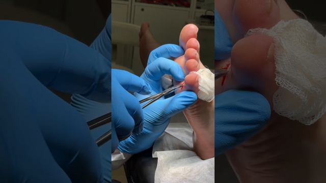 Вскрытие абцесса #подология #подолог #подологмосква #хирург #хирургия смотреть онлайн