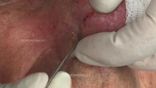 A Goldmine of Blackhead  Whitehead Extractions