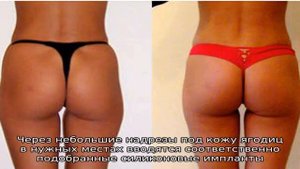 Лучшие способы убрать ямки на ягодицах