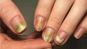 Лечение грибка ногтей народными средствами.