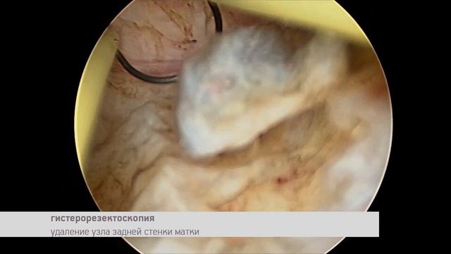 Лейомиома матки смотреть онлайн