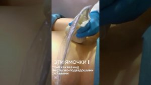 Кресцово- подвздошные суставы. Введения ПЛЕКСАТРОНА С УЗИ навигацией.