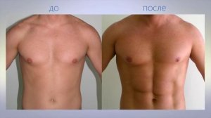 Липосакция у мужчин: какая процедура вам подойдет
