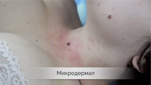 Микродермал – установка в яремную ямку | Пирсинг Самара