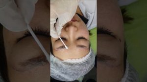 Удаление ремувером Revivink