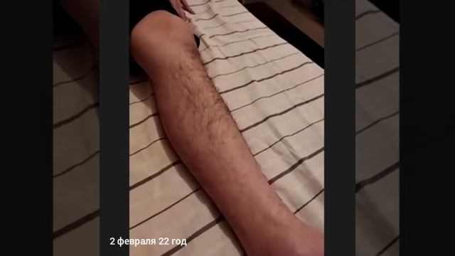 Комплекс упражнений при переломе позвоночника.