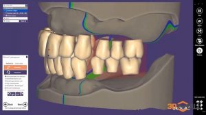 Exocad Denture module | Модуль съемных протезов