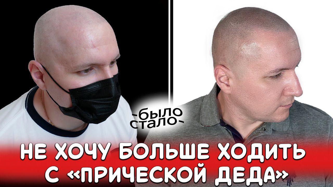 Не хочу больше ходить с прической деда! Трихопигментации при облысении лучше чем пересадка волос SMP