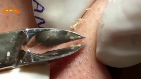 Удаление прыщей с носа и щек Spa #073