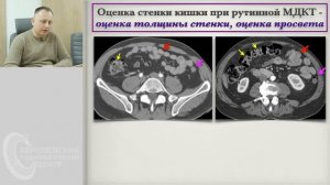 Часть 1. КТ брюшной полости - системный анализ поражений. Андрей Мангов