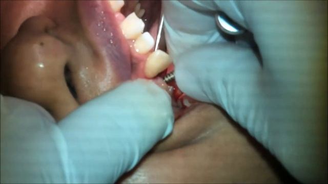 Dental Implant Using Ridge Expansion and Crestal Sinus Lifting смотреть онлайн