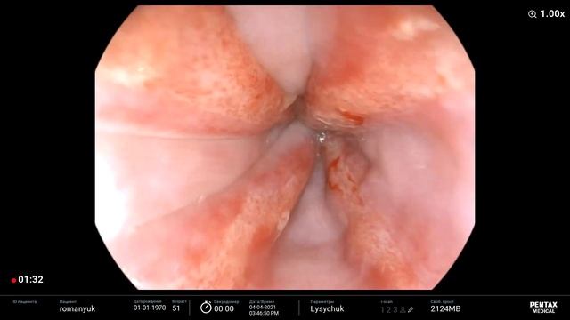 Эрозии пищевода смотреть онлайн