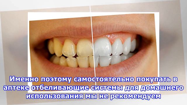 Что нужно знать об отбеливании зубов и можно ли отбелить зубы в домашних условиях