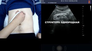 Как проводиться УЗИ поджелудочной железы?