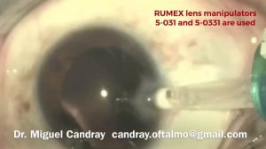 Implantation of soft hydrophilic aspheric RUMEX Hydro-4 IOL.