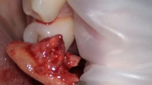 удаление 4.6 (HD)