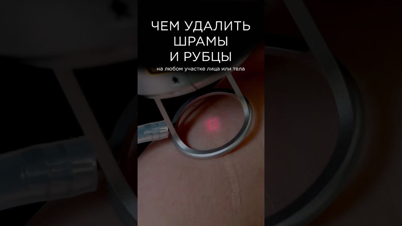 Коррекция шрамов и рубцов СО2 лазером #co2лазер #удалениешрамов