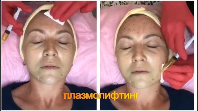 Неабляционное лазерное омоложение смотреть онлайн