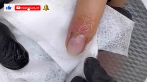 Рана под ногтем / грануляция под кутикулой / трещина на ногте