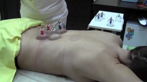 Снимаем боль в спине вакуумными банками
