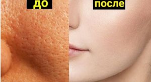 КАК ИЗБАВИТЬСЯ ОТ БОЛЬШИХ ПОР И ПОЛУЧИТЬ ГЛАДКУЮ КОЖУ _ Доктор Вивек