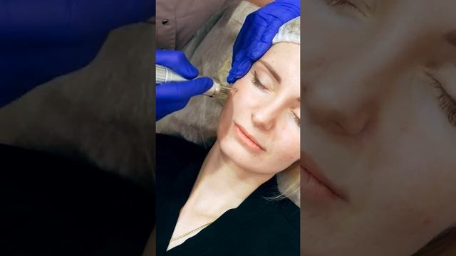 Дермальное лазерное омоложение лица