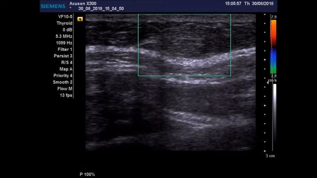 Липома грудной клетки смотреть онлайн