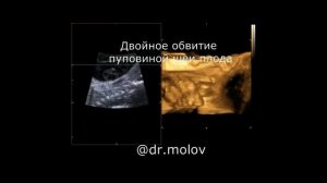 Обвитие пуповиной плода на УЗИ