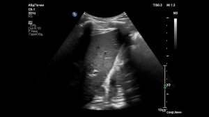 ОБРАЗОВАНИЕ НАДПОЧЕЧНИКА на УЗИ. КАМЕНЬ И КИСТА ПОЧКИ. RENAL & ADRENAL ULTRASOUND.