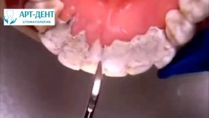 Ультразвуковая чистка зубов и Air Flow