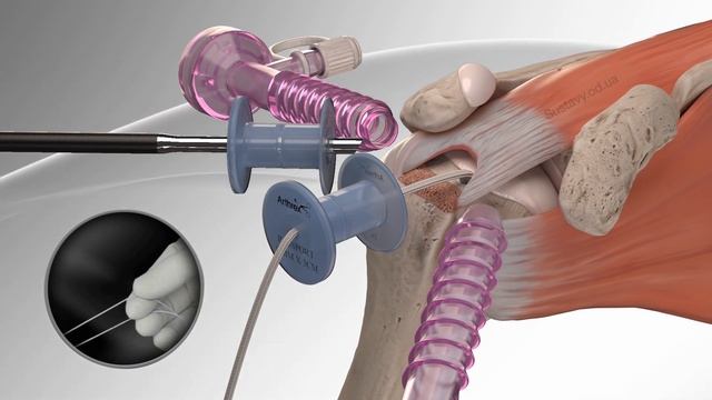 Восстановление надостной мышцы плеча смотреть онлайн