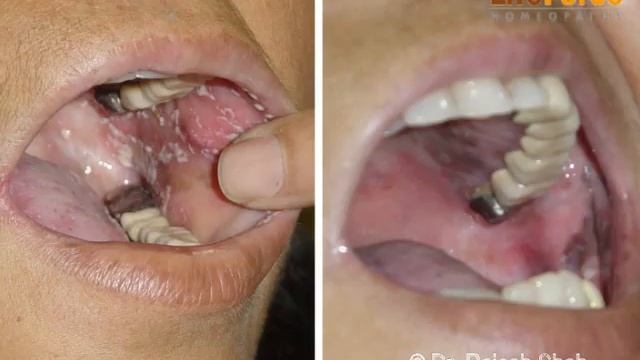 Lichen Planus awareness series- A case of Oral Lichen Planus treated at Life Force смотреть онлайн
