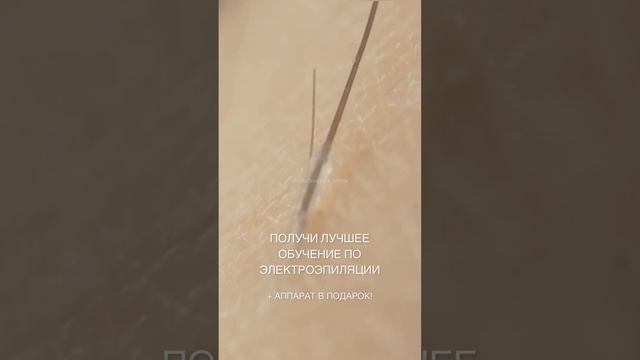 Как происходит электроэпиляция
