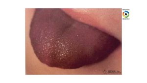 Что значит Белый налет на языке. Диагноз По Языку