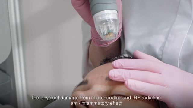 Мікроголковий RF VIVACE | Leo Beauty Club смотреть онлайн