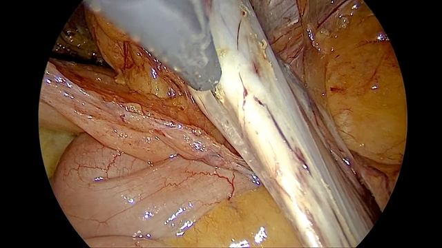 Правосторонняя пахово-мошоночная грыжа больших размеров. Лапароскопическая герниопластика (ТАРР). смотреть онлайн