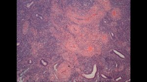 Железистый полип эндометрия: критерии диагностики